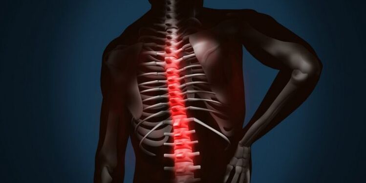 lesioni spinali dovute a osteocondrosi